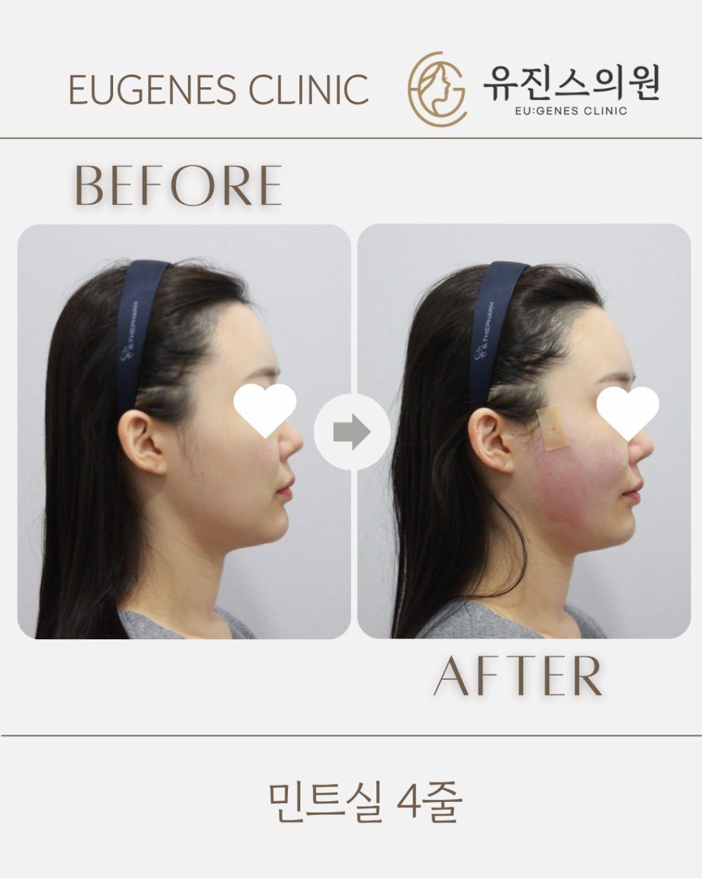 Thread lift before and after in Seoul, MINT thread lift, 4 threads, EU:GENES Skin Clinic Apgujeong