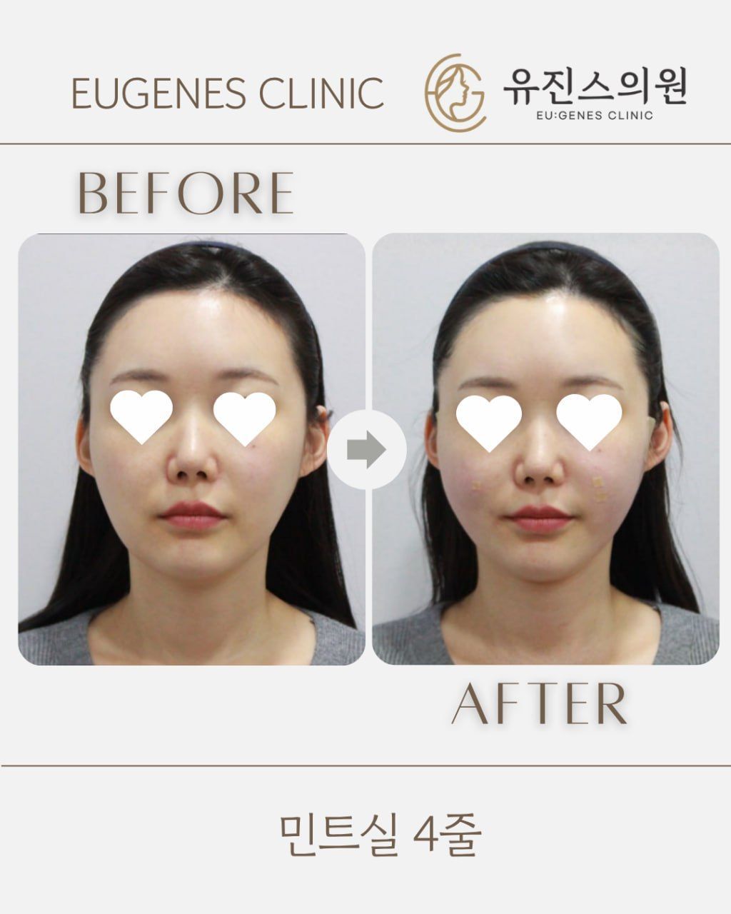 Thread lift before and after in Seoul, MINT thread lift, 4 threads, EU:GENES Skin Clinic Apgujeong