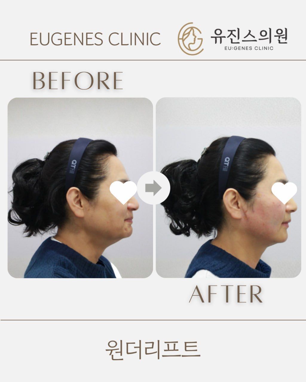 Thread lift before and after in Seoul, Wonder Lift thread lift, EU:GENES Skin Clinic Apgujeong