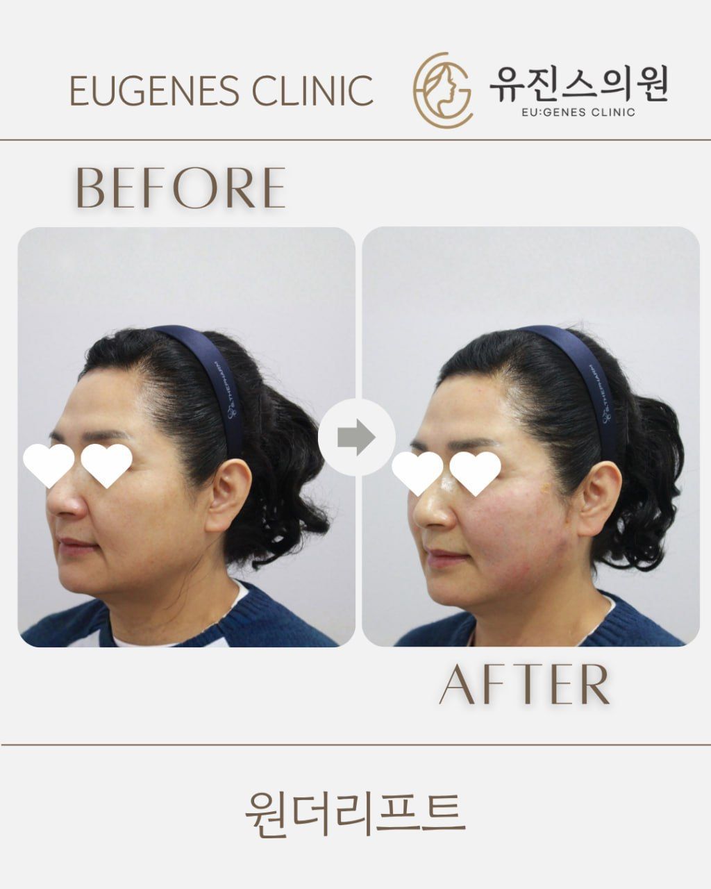 Thread lift before and after in Seoul, Wonder Lift thread lift, EU:GENES Skin Clinic Apgujeong