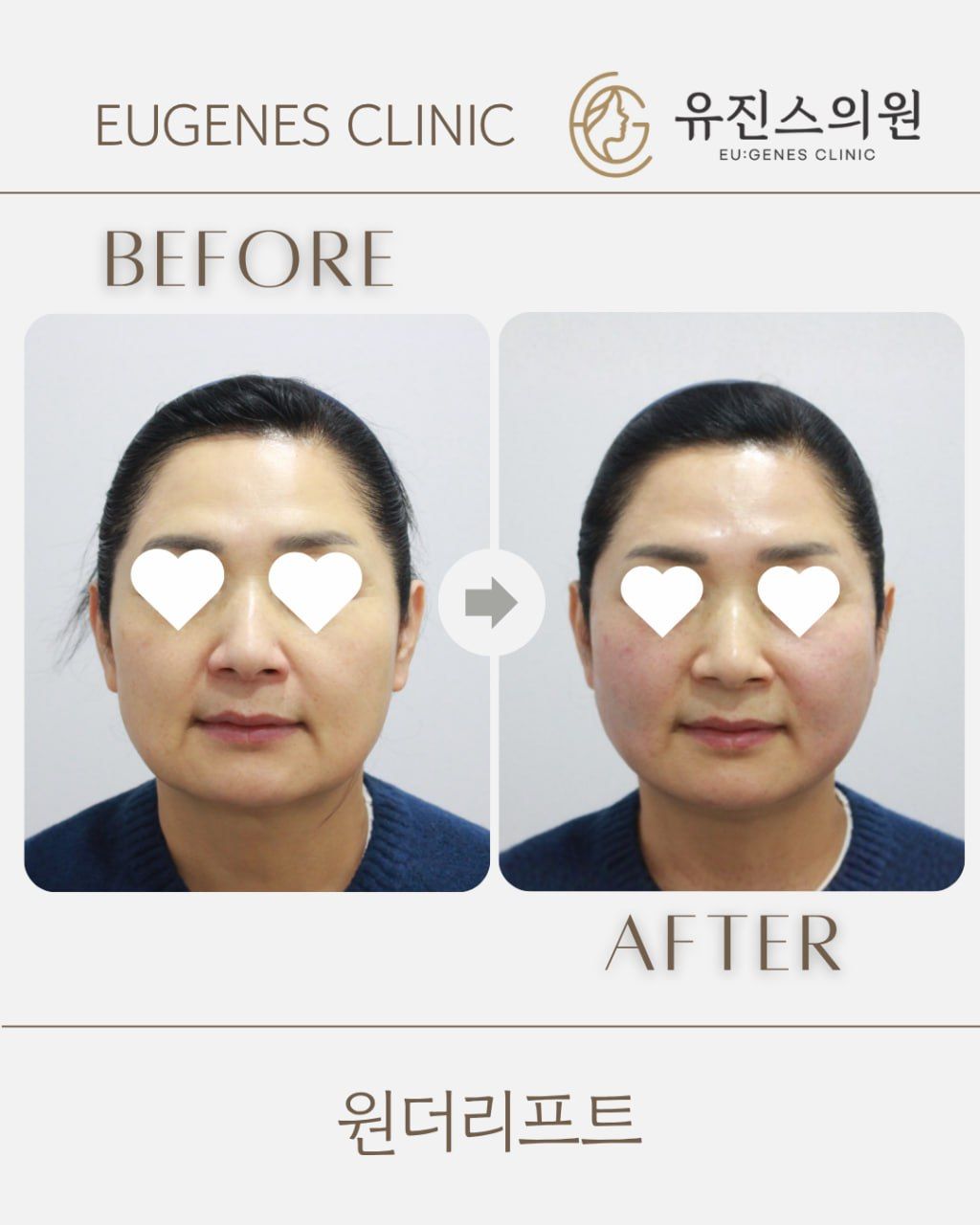 Thread lift before and after in Seoul, Wonder Lift thread lift, EU:GENES Skin Clinic Apgujeong
