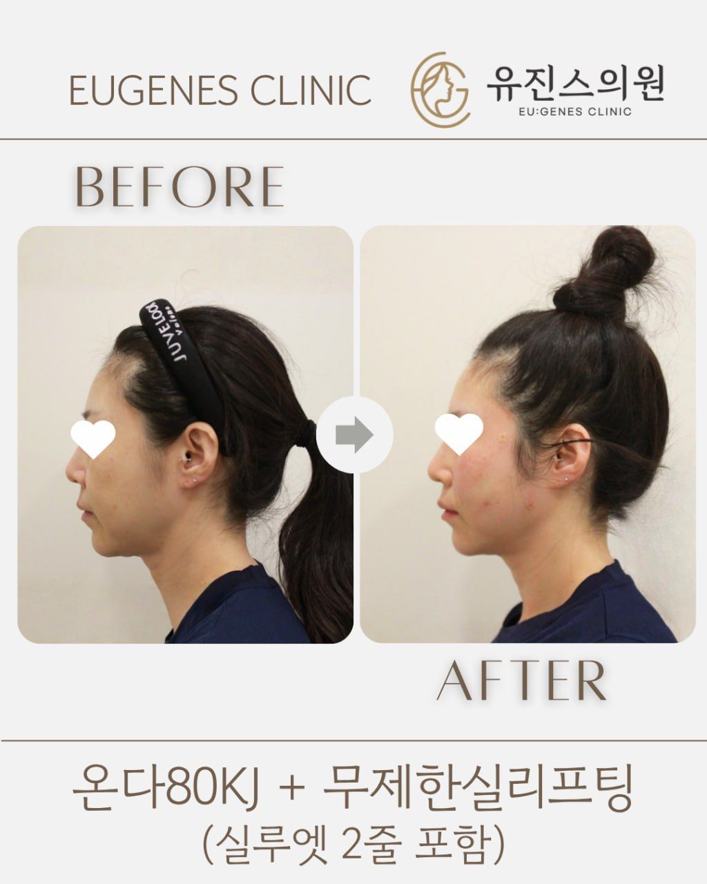 Thread lift before and after in Seoul, Onda 80KJ + unlimited thread lifting (incl. 2 Silhouette Soft), EU:GENES Skin Clinic Apgujeong