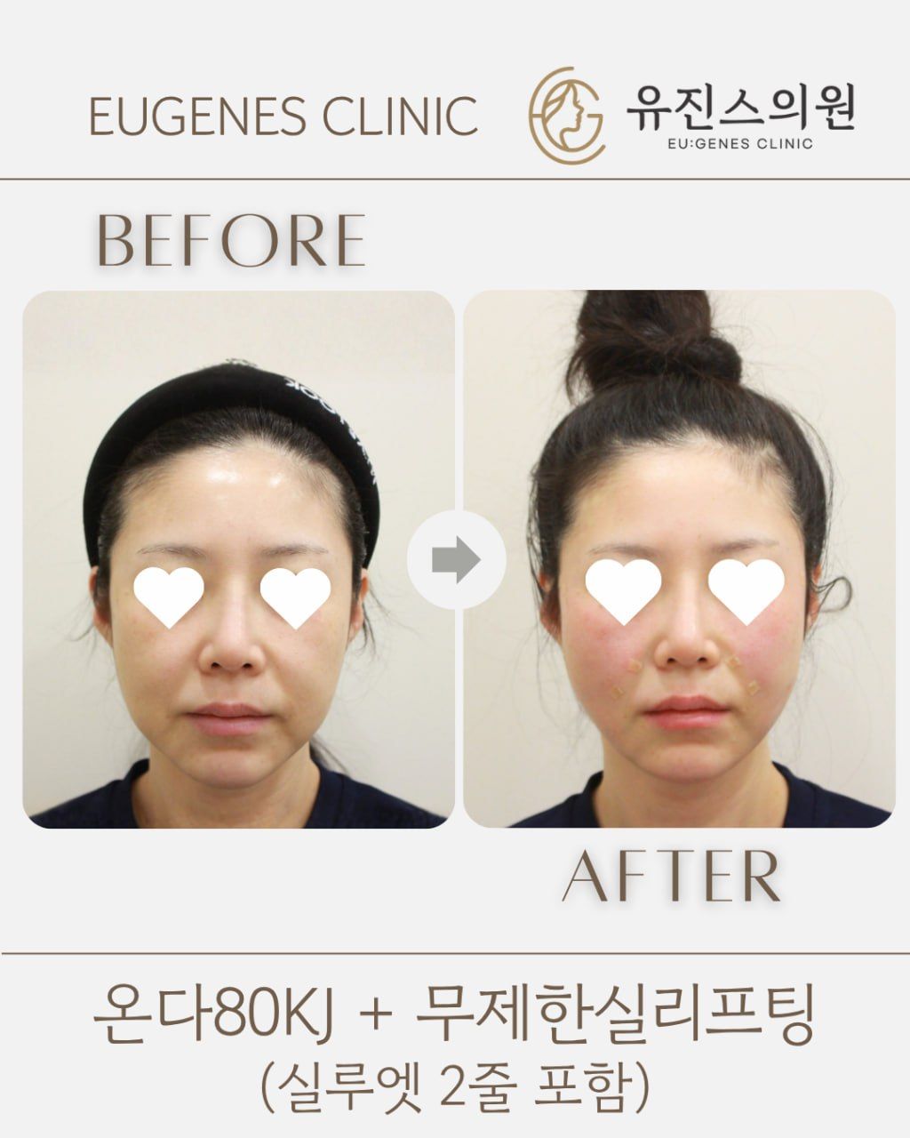 Thread lift before and after in Seoul, Onda 80KJ + unlimited thread lifting (incl. 2 Silhouette Soft), EU:GENES Skin Clinic Apgujeong