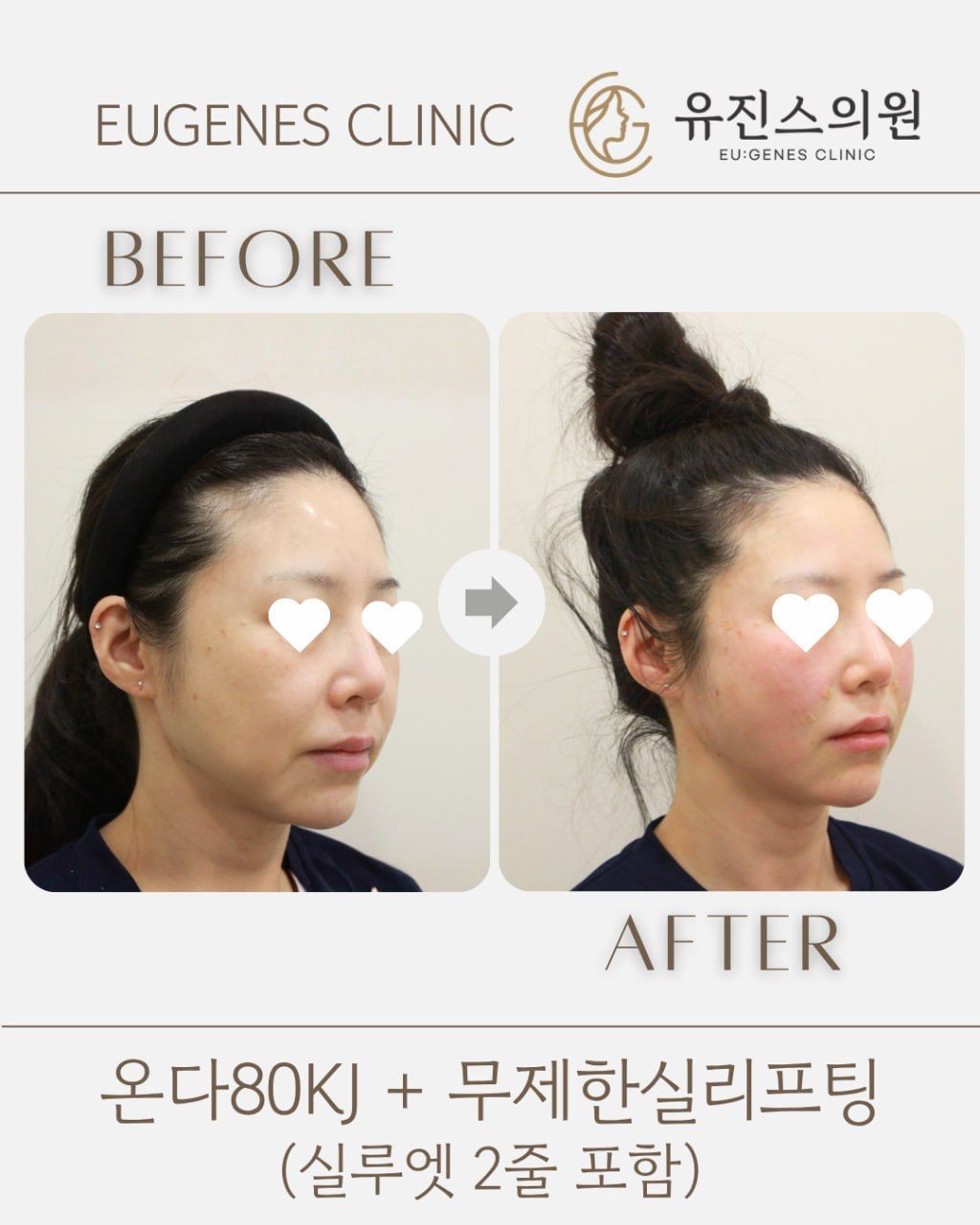 Thread lift before and after in Seoul, Onda 80KJ + unlimited thread lifting (incl. 2 Silhouette Soft), EU:GENES Skin Clinic Apgujeong