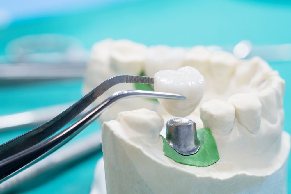 A Close Up Of A Model Of A Tooth With A Dental Crown On It — Regal's Dental In Yeppoon, QLD