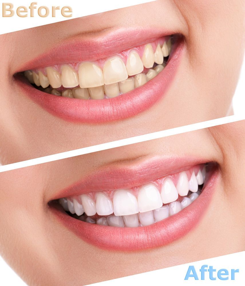 A Before And After Picture Of A Woman's Teeth — Regal's Dental In Yeppoon, QLD