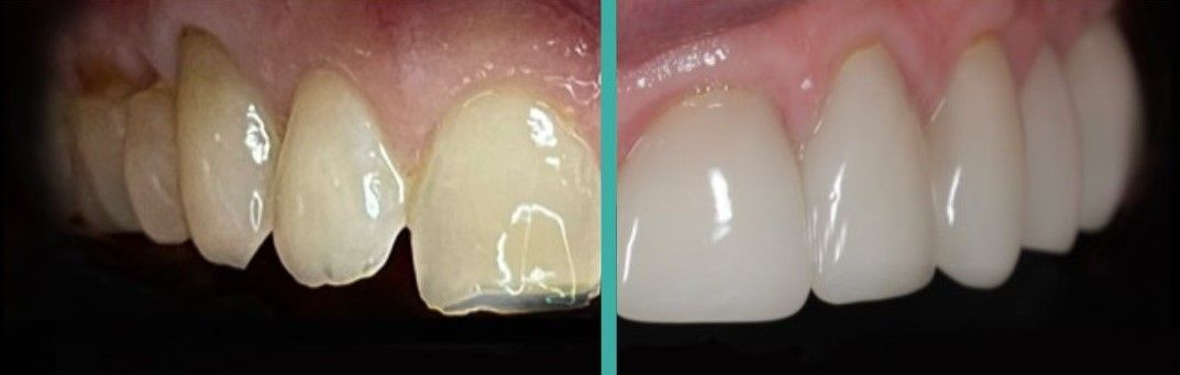 a before and after picture of a person 's teeth .