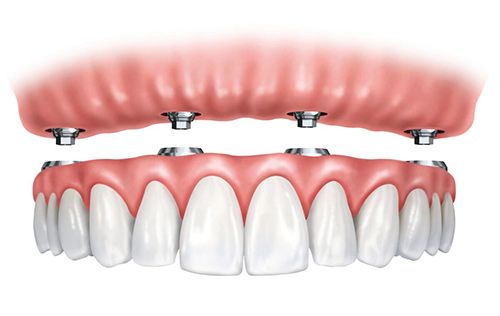 a close up of a person 's teeth with braces on them .