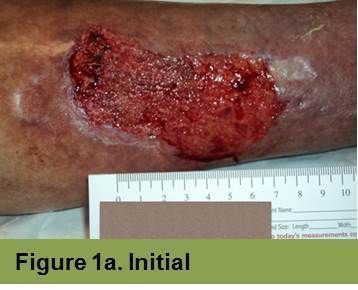 Foot with open wound on big toe. The wound has red tissue and a yellow-white border.