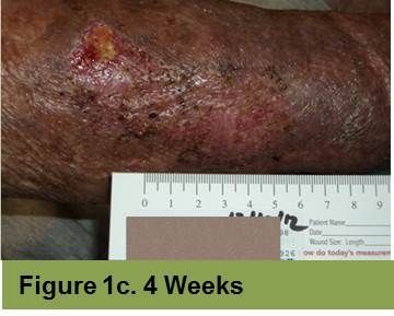 Foot with an open sore on the toe, showing redness and potential tissue damage; the image has a week 5 caption.