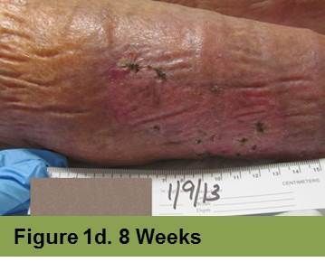 A close-up of skin with healing lesions and redness, labeled