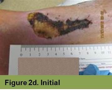 A medical close-up of a leg ulcer with dark eschar and yellow slough, positioned above a measuring scale.