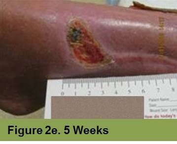 A chronic leg ulcer with surrounding tissue discoloration, measured by a ruler beneath the wound. Label reads Figure 2e.