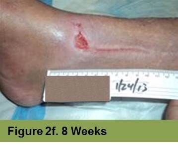 A close-up view of a healing lower leg wound with a measuring tape and the text