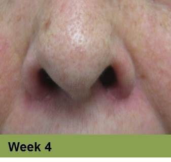Heel ulcer, open wound. Brown skin with a deep, red sore. Week 0.