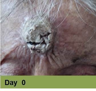 Close-up of a wound on skin, with ruler for scale. Wound is open, bloody, surrounded by inflamed, discolored skin.