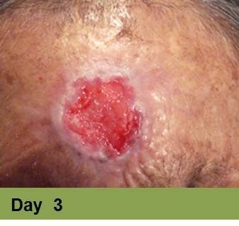 A close-up view of a red, circular, open wound or ulcerated lesion on a patch of skin, labeled