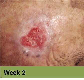 A close-up of a circular skin lesion with a red, ulcerated center and surrounding pale, textured skin, labeled