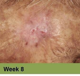 A skin lesion with central scarring, pinkish-white borders, and small red spots, labeled