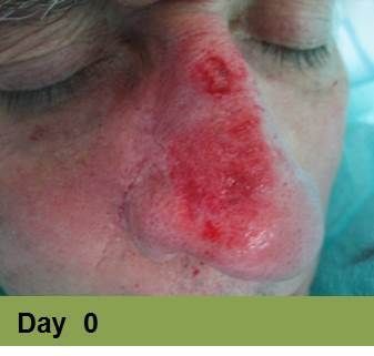Foot with deep, open ulcer. Skin is swollen and discolored. The ulcer is reddish with exposed tissue.
