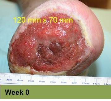 Foot with a large, open wound; measured as 120 mm x 70 mm. The wound is red and brown, and healing progress is at