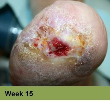 Foot with open ulcer, red tissue, yellow and dry skin, stage 15.