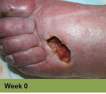 Foot with deep, open ulcer. Skin is swollen and discolored. The ulcer is reddish with exposed tissue.