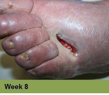 Foot with a deep, open wound, swollen toes, and discoloration.