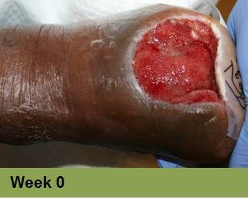Heel ulcer, open wound. Brown skin with a deep, red sore. Week 0.