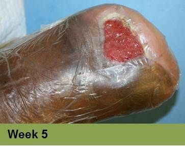 Foot with a large, open wound, wrapped in clear dressing; labeled