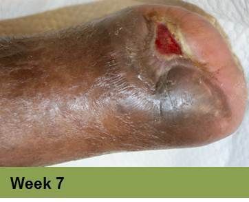 Foot with a deep, open wound on the heel, surrounded by discolored skin.