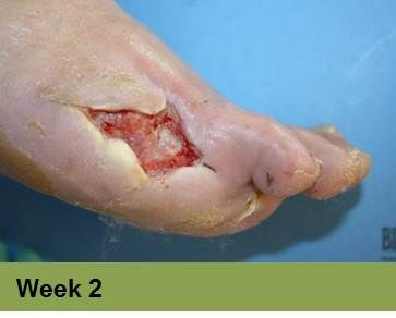 Foot with an open wound, Week 2. Skin is torn, revealing red flesh.