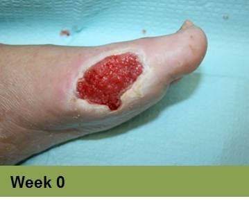 Foot with open wound on big toe. The wound has red tissue and a yellow-white border.