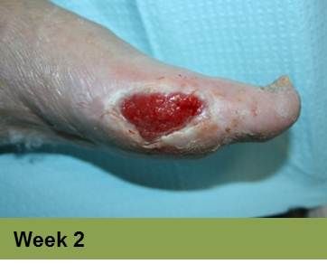 Foot with a deep, red ulcer on the ball, with slight discoloration; week 2 of treatment.