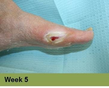 Foot with an open sore on the toe, showing redness and potential tissue damage; the image has a week 5 caption.