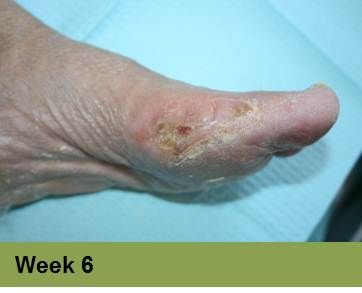 Foot with healing wounds, possibly diabetic, at week 6. Light skin, indoors setting.