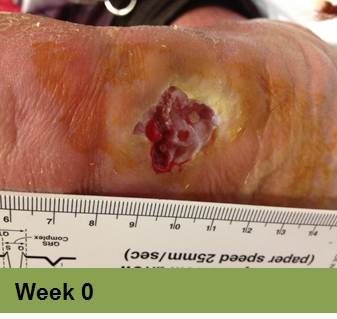 Close-up of a wound on skin, with ruler for scale. Wound is open, bloody, surrounded by inflamed, discolored skin.
