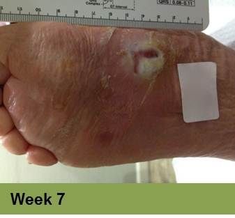 Hand with a healing wound, ruler, and bandage; week 7.