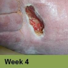 Wound on leg, Week 4. The open sore is reddish-brown with surrounding pale skin.