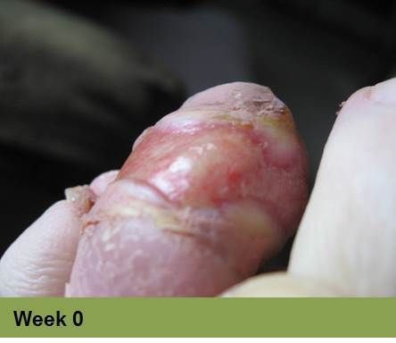 Foot with open wound on big toe. The wound has red tissue and a yellow-white border.