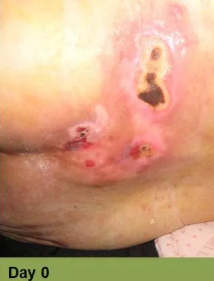 Close-up of a wound on skin, with ruler for scale. Wound is open, bloody, surrounded by inflamed, discolored skin.
