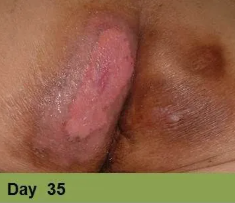 A close-up view of an area of inflamed, reddened, and raw-looking skin in the gluteal cleft, labeled