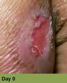 Foot with deep, open ulcer. Skin is swollen and discolored. The ulcer is reddish with exposed tissue.