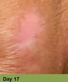 Wound on leg, Week 4. The open sore is reddish-brown with surrounding pale skin.
