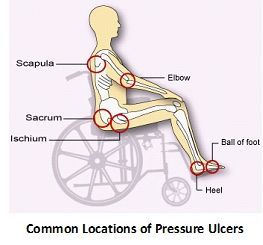 Diagram showing a person in a wheelchair with red circles highlighting common areas for pressure ulcers.