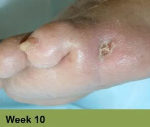 Close-up of a swollen toe with a small, crusty skin lesion on the side, labeled
