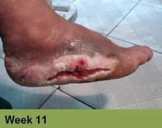 Heel with severely damaged skin, possibly a pressure ulcer, displaying dark discoloration.