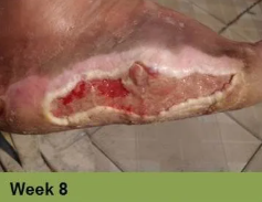 Foot with a deep, open wound on the heel, surrounded by discolored skin.