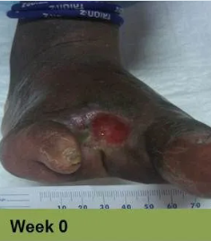 Foot with a large, open wound; measured as 120 mm x 70 mm. The wound is red and brown, and healing progress is at