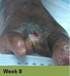 Foot with open ulcer, red tissue, yellow and dry skin, stage 15.